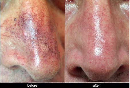 capillaries on nose before and after laser treatment