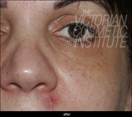Gemini Laser Case Study - After dermatosis papulosa nigra Laser Case Study - After