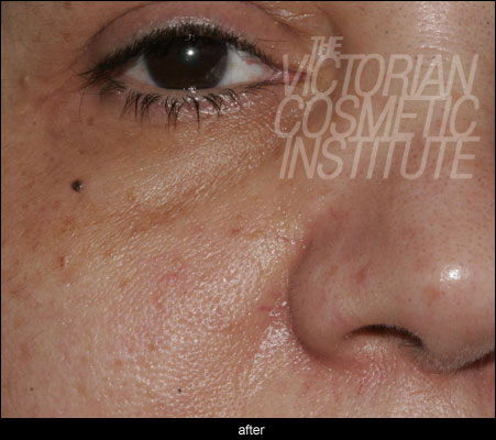 Gemini Laser Case Study - After dermatosis papulosa nigra Laser Case Study - After