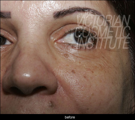 Gemini Laser Case Study - Before dermatosis papulosa nigra Laser Case Study - Before