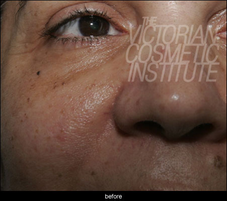 Gemini Laser Case Study - Before dermatosis papulosa nigra Laser Case Study - Before