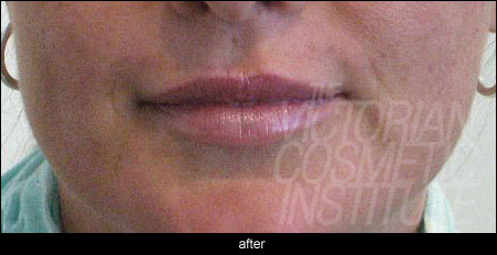 Lip Enhancement - After Lip fillers melbourne after photo