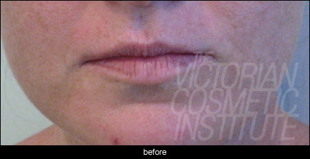 Lip Enhancement - Before lip fillers melbourne before photo