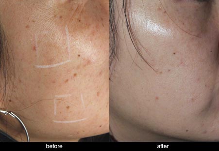 laser treatment asian pigmentation before and after
