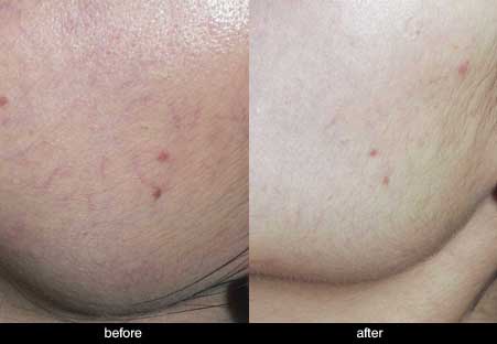facial veins before and after treatment with laser
