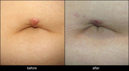 Keloid Scar Case Study