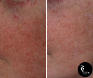 vascular laser treatment