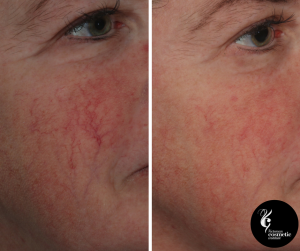 vascular laser treatment before and after