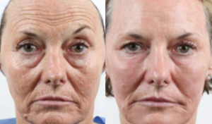 skin resurfacing treatment before and after melbourne