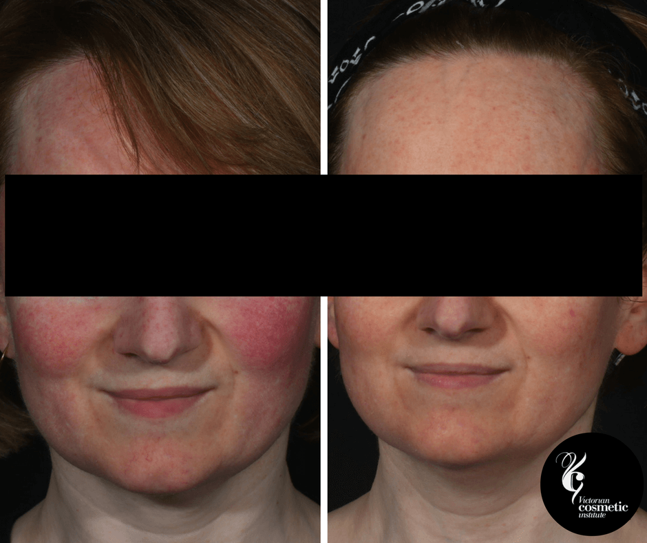 rosacea with led light therapy