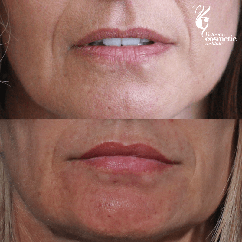 lip fillers melbourne