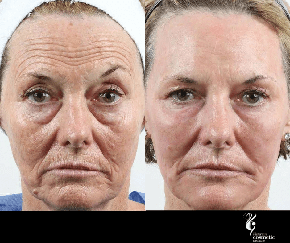 ns skin tightening