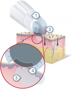 dermafrac treatment melbourne