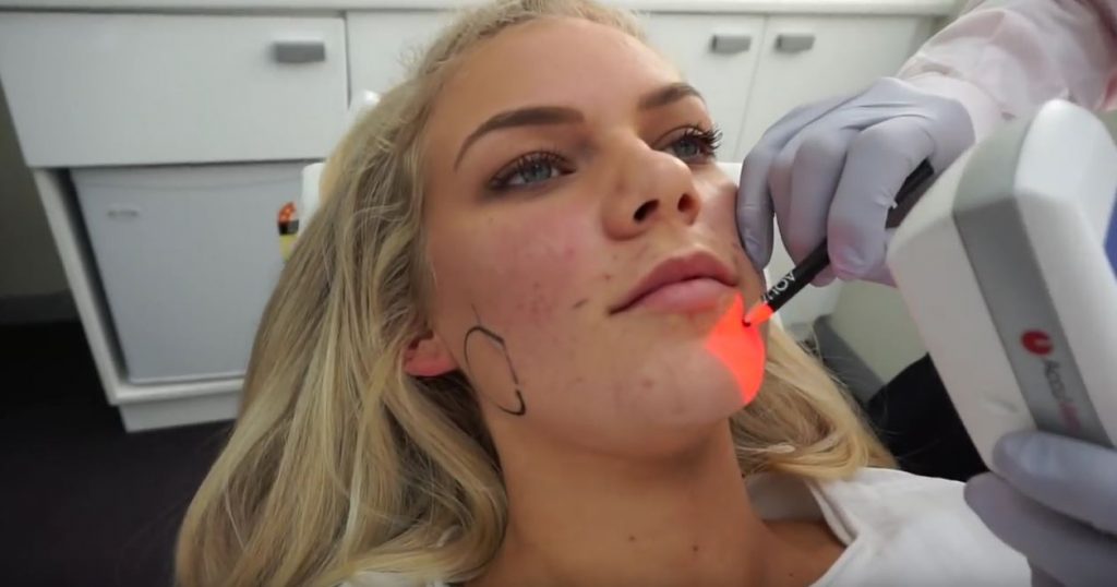 Accuvein to find Chloe's veins before cosmetic injections