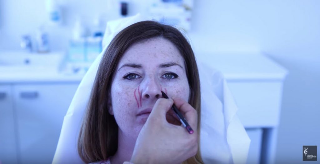 Levator Labii Superioris Alaeque Nasi muscle