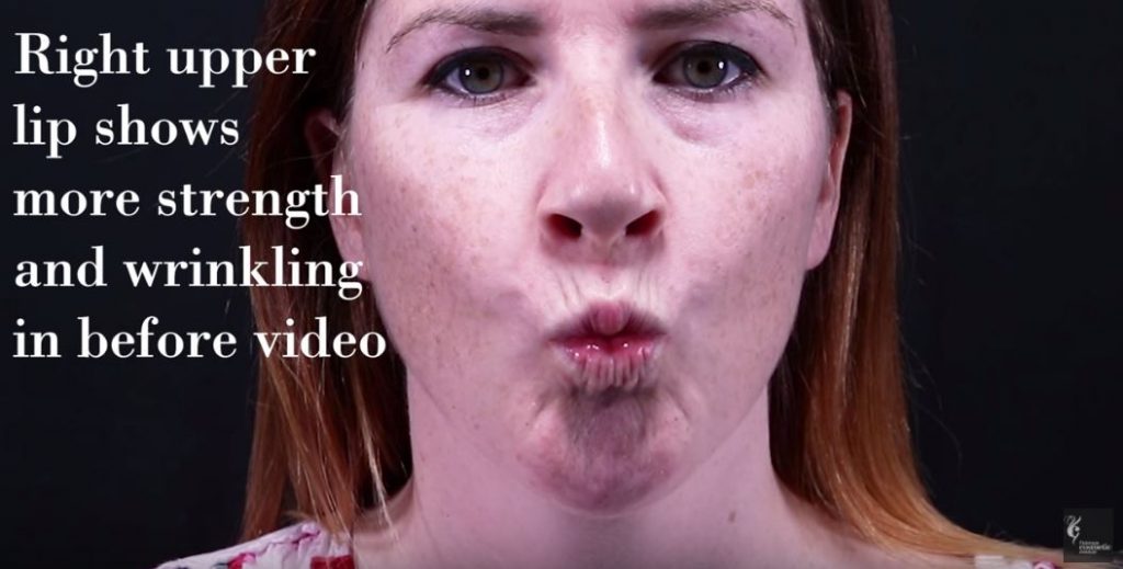 Upper right lip uneven