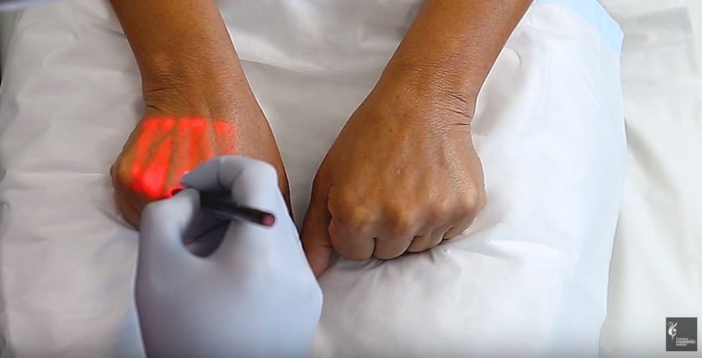 Dr Davin Chan Accuvein for hands