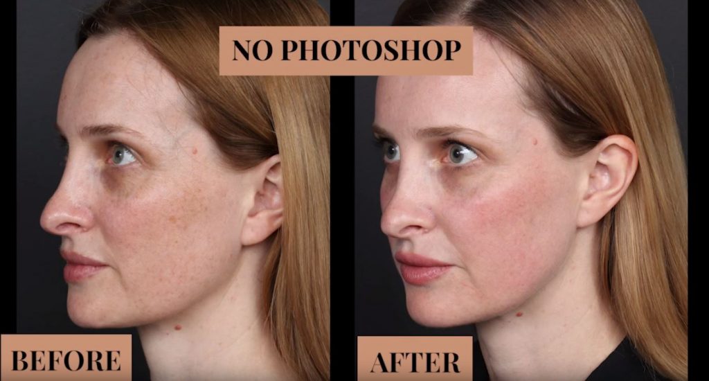 before and after photo of non-surgical facial rejuvenation without any photoshop