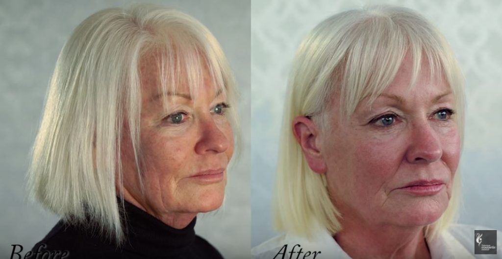 Before after treatment