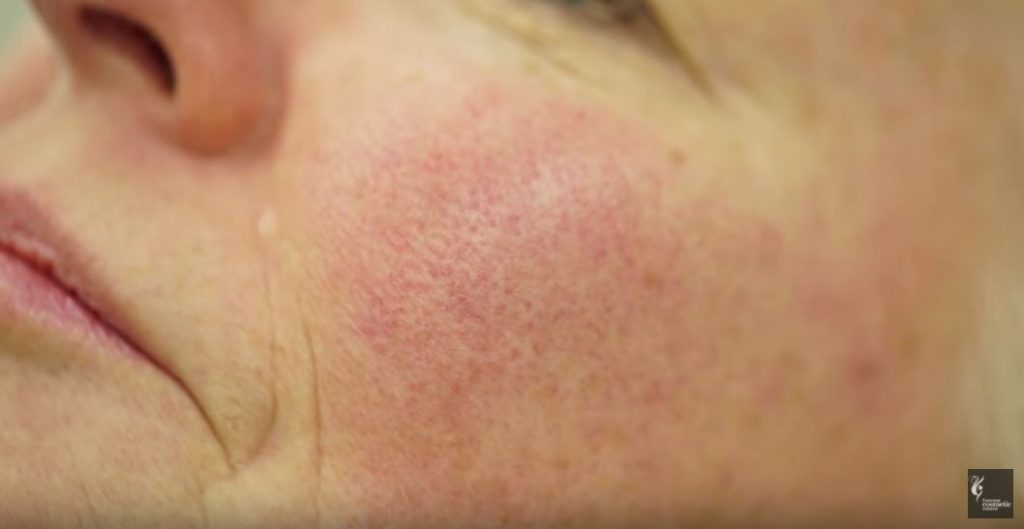 Up close face redness