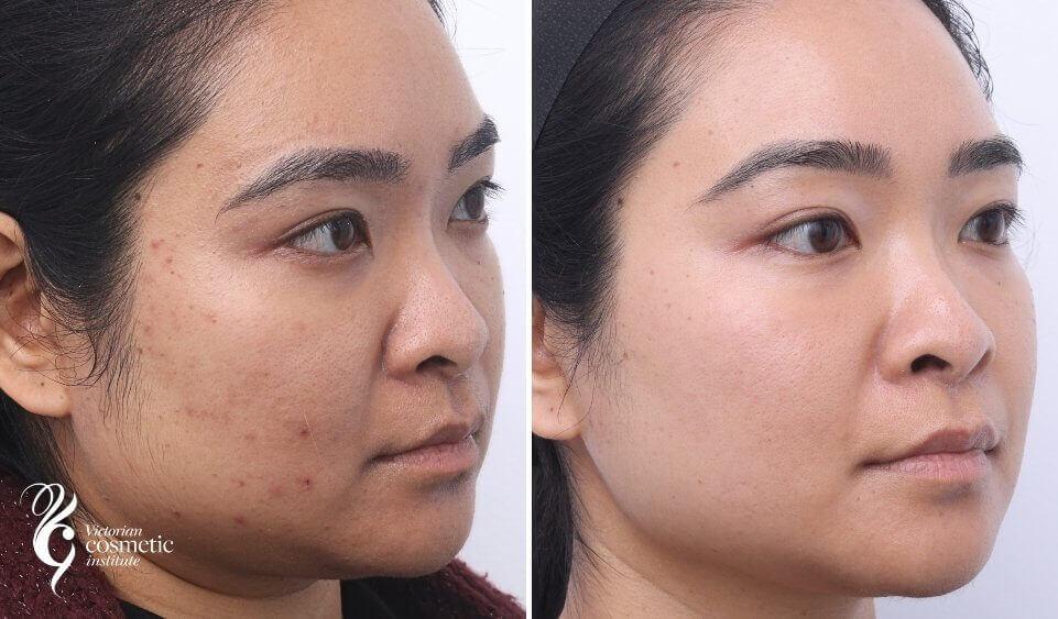 before and after chemical peels for acne treatment melbourne
