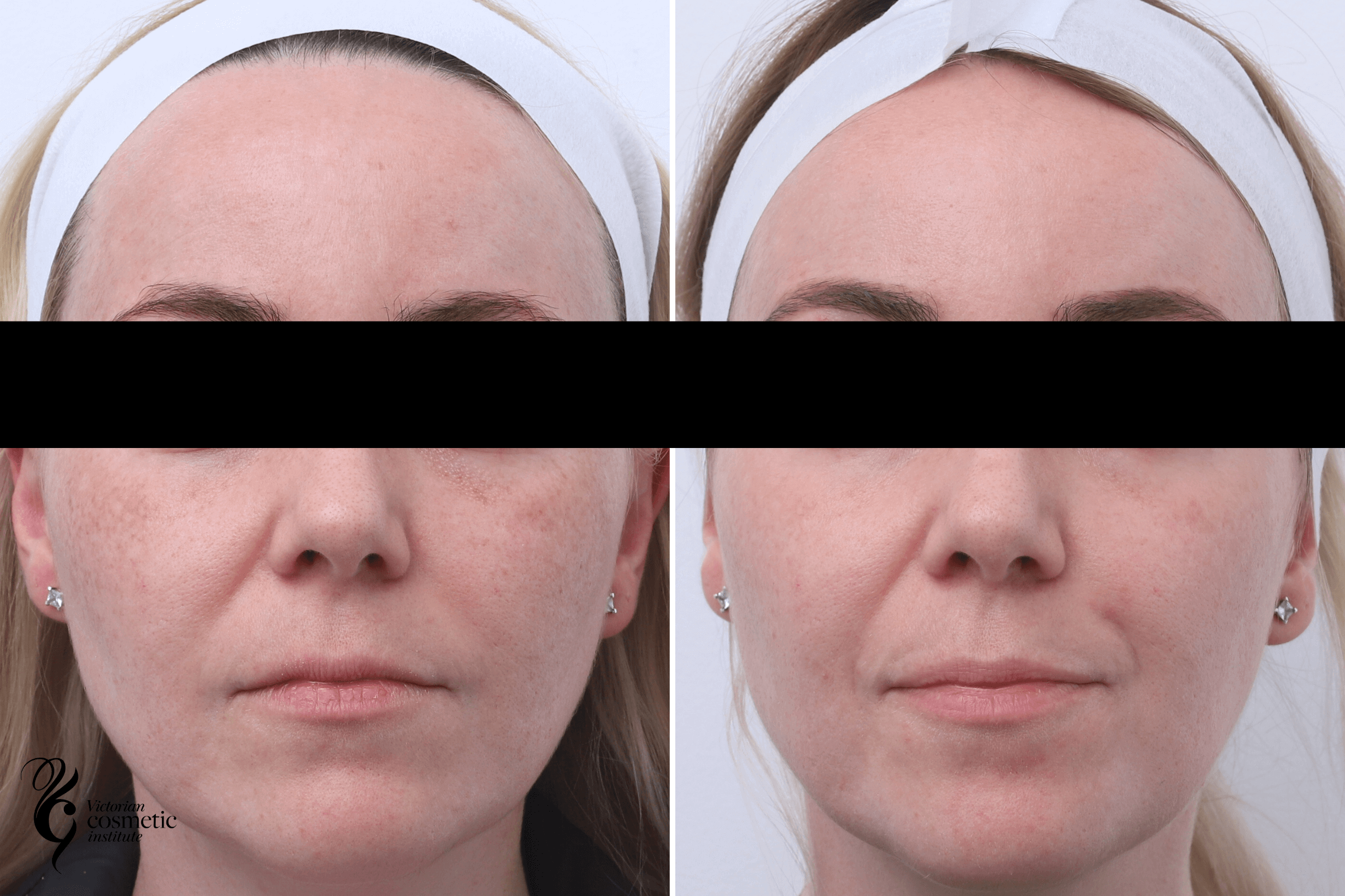 melasma treatment melbourne