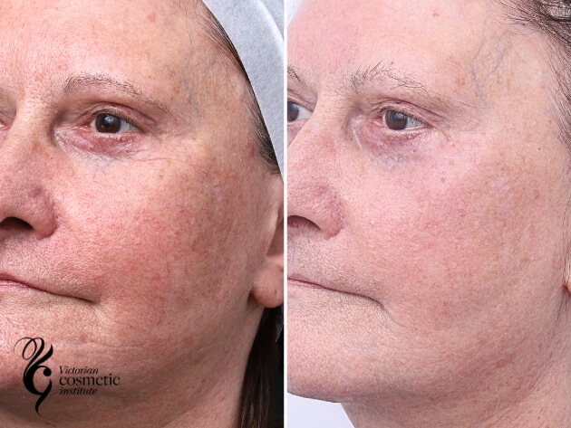 excel v+ vascular laser capillaries before and after