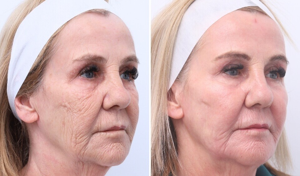 Co2 laser treatment melbourne