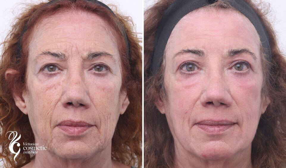 co2 before and after 3 months