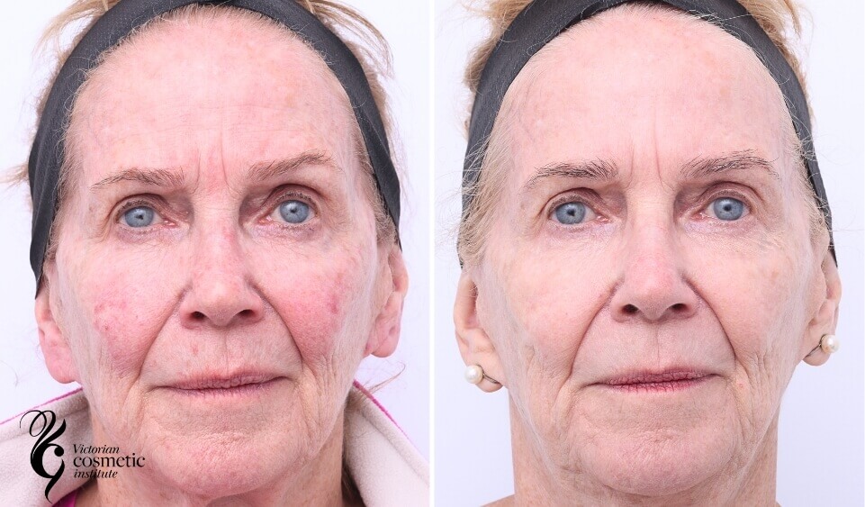 Fraxel, IPL and TCA peel before and after treatment melbourne