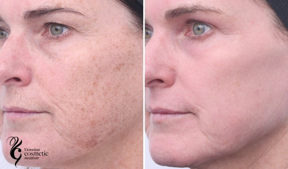 co2 laser pigmentation left cheek