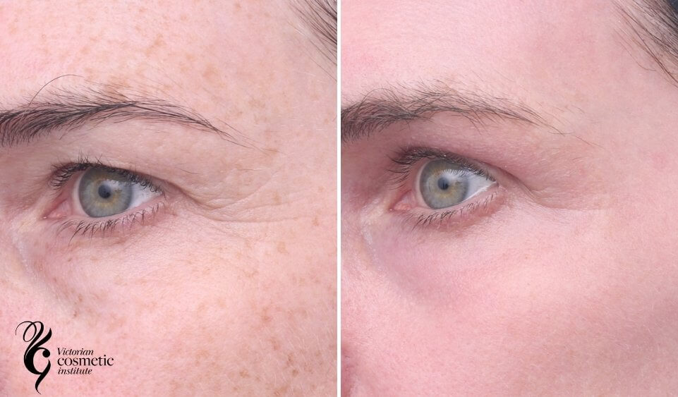 co2 laser left eye wrinkles