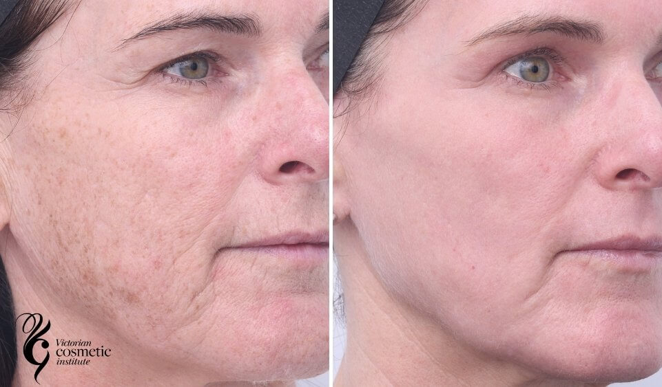 co2 laser pigmentation right cheek