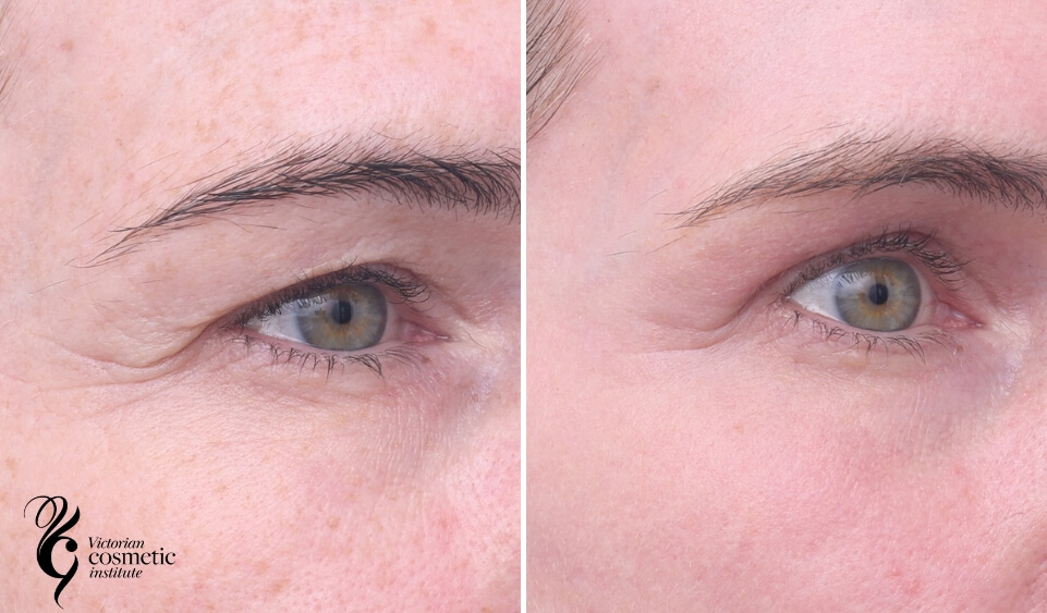 co2 laser right eye wrinkles