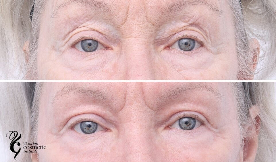 co2 upper eyes before and after