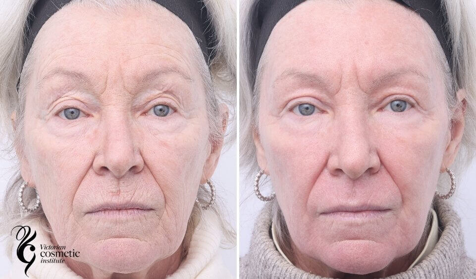 co2 laser treatment before and after