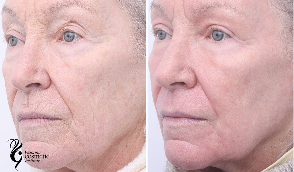 co2 laser resurfacing before and after left side face