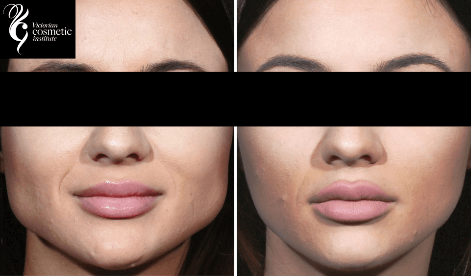 jawline slimming botox before and after