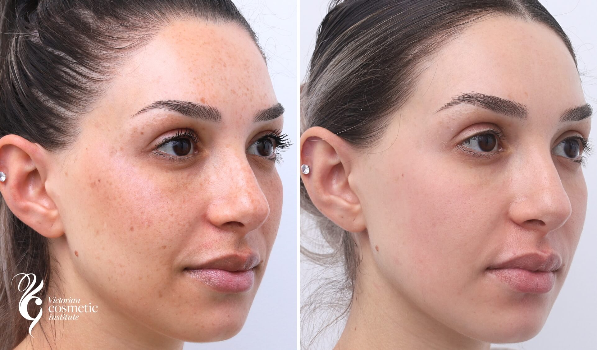 cosmelan peel for facial rejuvenation