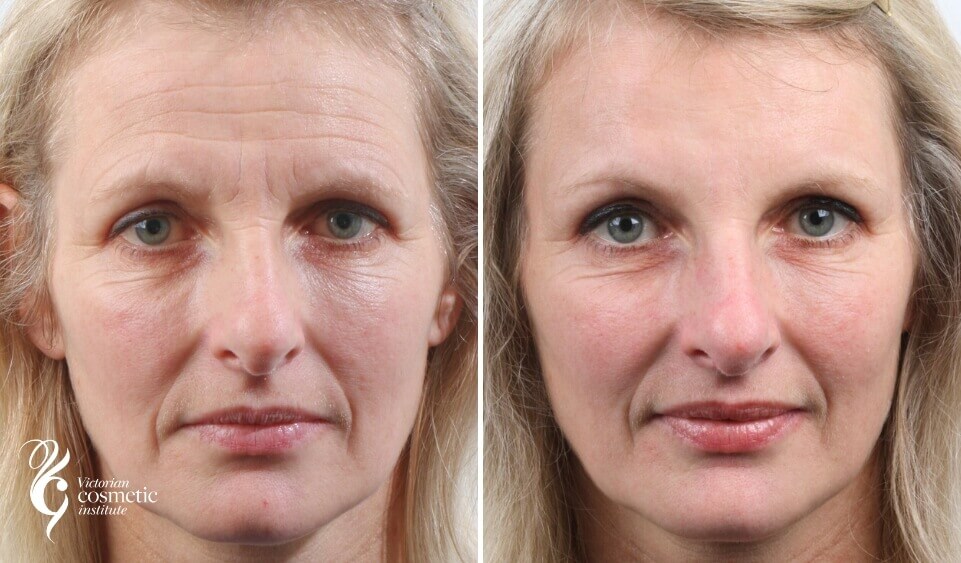 facial rejuvenation treatment melbourne