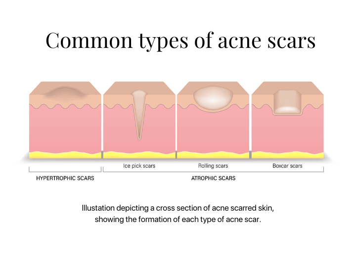 Common types of acne scars