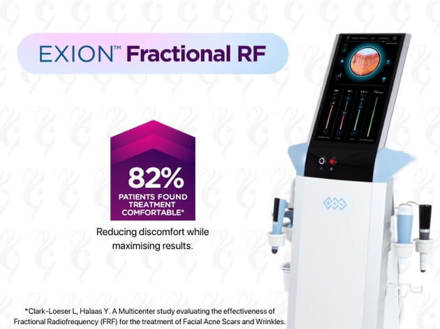 RF needling patient comfort EXION machine