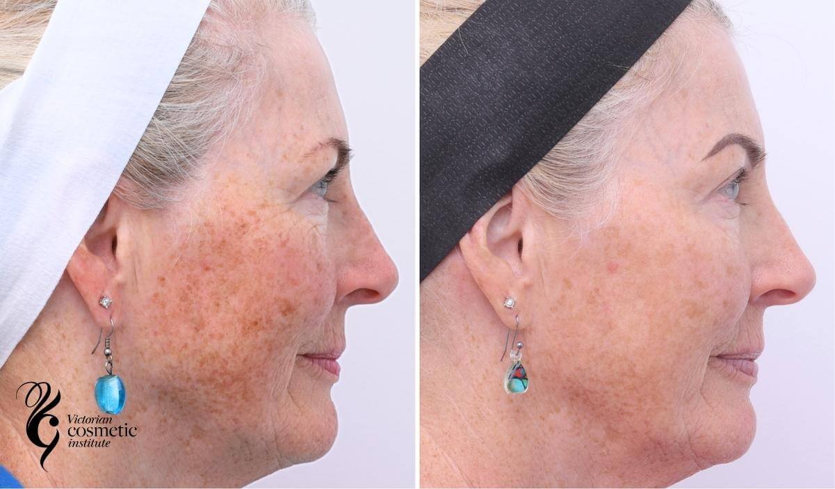 IPL pigmentation before and after 