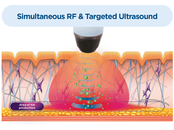 Exion Face treatment simultaneous RF and targeted ultrasound