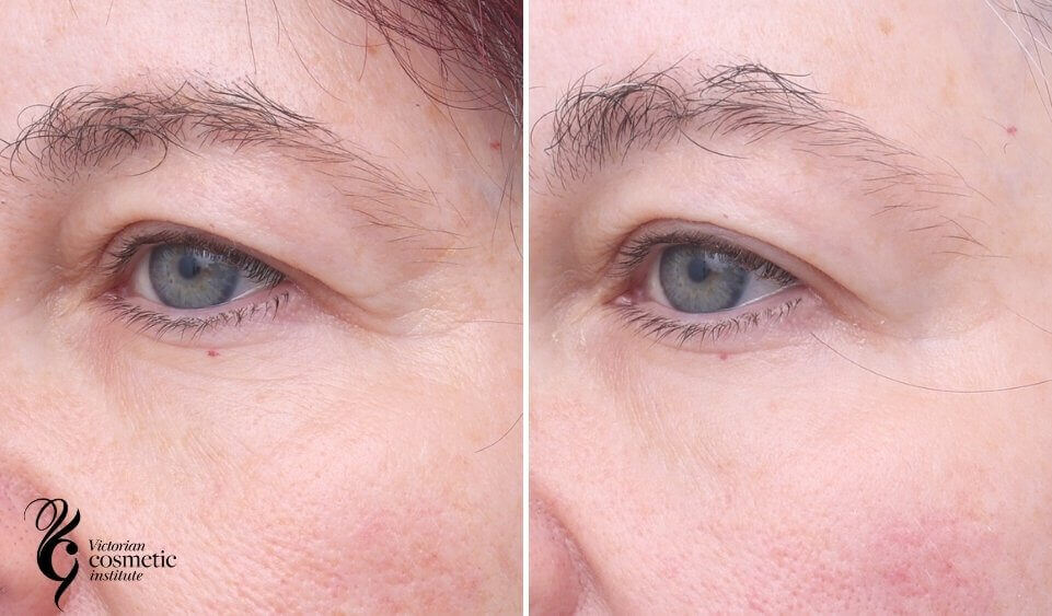 Exion Face before and after to the eye area