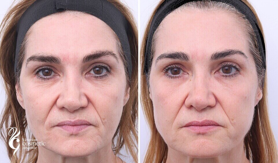 Rejuran treatment before and after melbourne