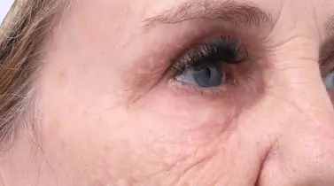 Tired Under Eyes: Symptoms, Causes and Treatment Options