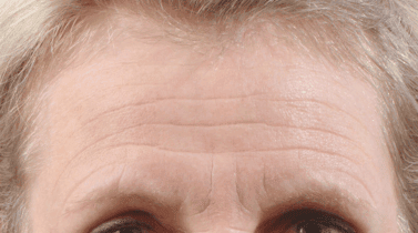 Why the Forehead Is the Most Problematic Area to Treat With Anti-Wrinkle Injections